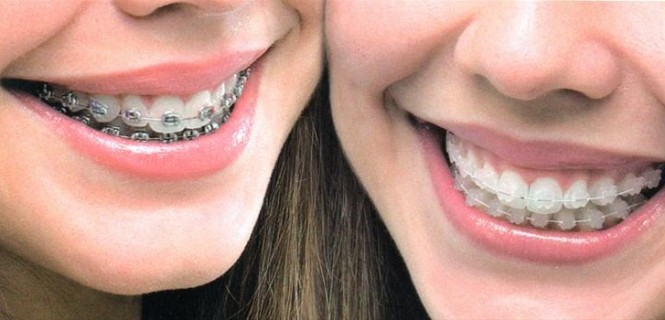 dente-665x320
